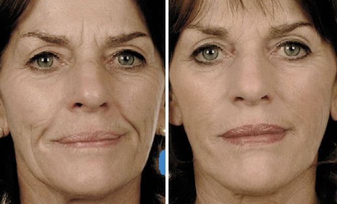Injectable Facial Fillers 112