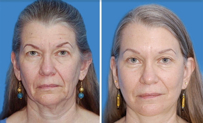 , Learn More About Eyelid Surgery at Boulder Plastic Surgery