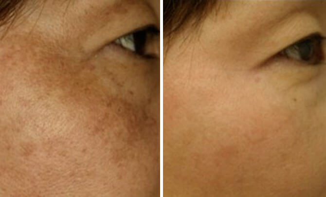 , Looking for Information on Scar Removal?
