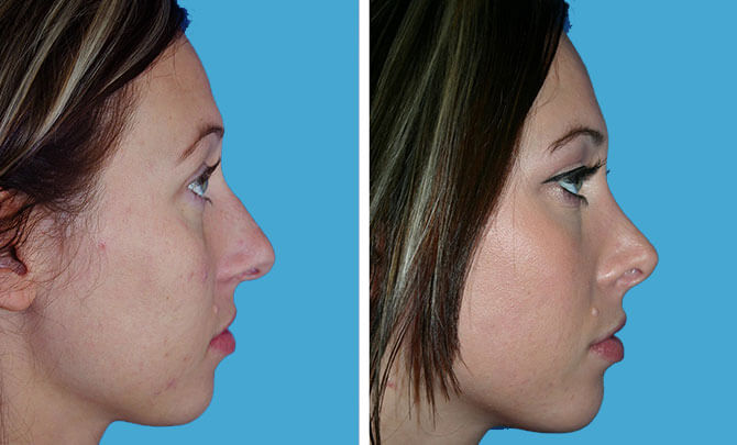 , Looking for Information on Rhinoplasty and Nose Reshaping Procedures?