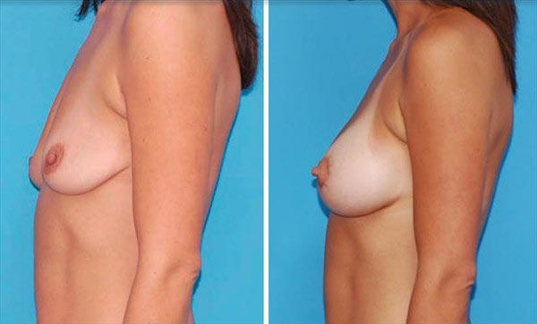 , Boulder Plastic Surgery Offers Breast Implants and Augmentation