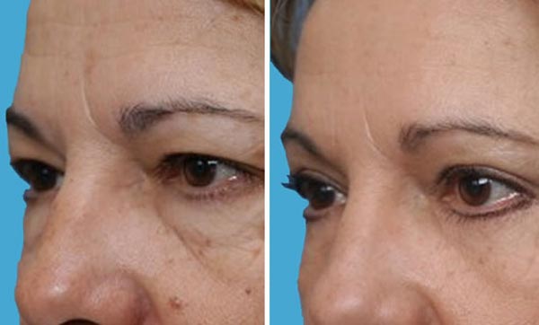 , Brow Lift Procedures Offered at Boulder Plastic Surgery