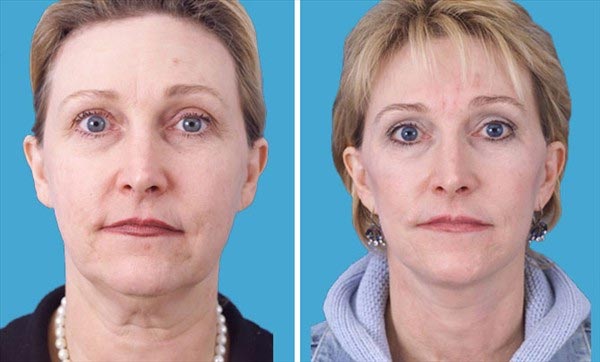 , Learn More About Facelift Surgery at Boulder Plastic Surgery