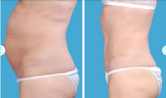 , Visit Boulder Plastic Surgery for One of Our Tummy Tuck Procedures