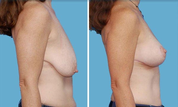 , Are You a Good Candidate for a Mastopexy or Breast Reduction?