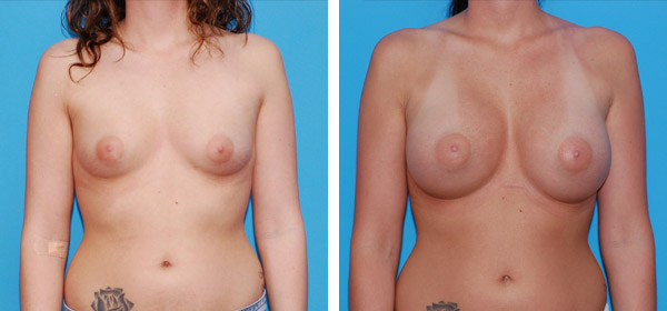 , Breast Augmentation &#8211; Patient 1