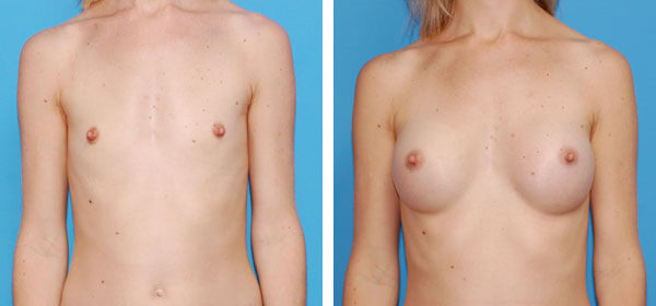 , Breast Augmentation