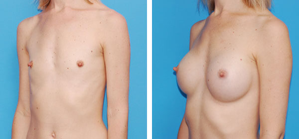 , Breast Augmentation &#8211; Patient 2