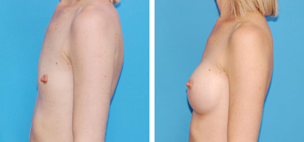 , Breast Augmentation &#8211; Patient 2