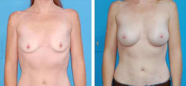 , Breast Augmentation &#8211; Patient 10