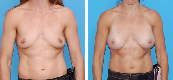 , Breast Augmentation &#8211; Patient 3