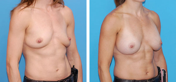 , Breast Augmentation &#8211; Patient 3