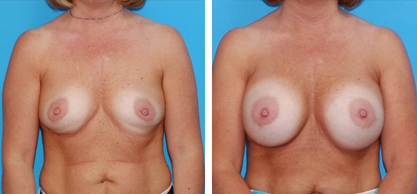 , Breast Augmentation &#8211; Patient 4
