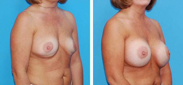 , Breast Augmentation &#8211; Patient 4