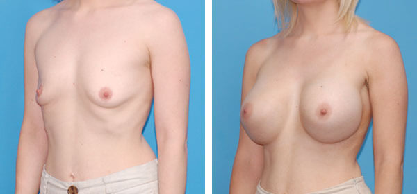 , Breast Augmentation &#8211; Patient 5