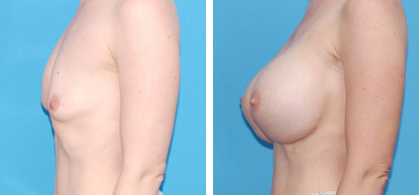, Breast Augmentation &#8211; Patient 5