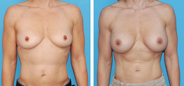 , Breast Augmentation &#8211; Patient 7