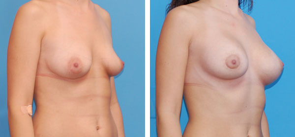 , Breast Augmentation &#8211; Patient 8