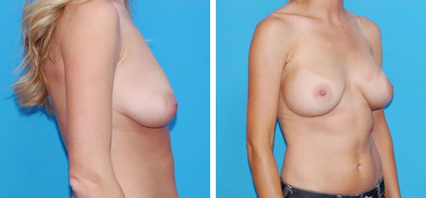, Breast Augmentation &#8211; Patient 11