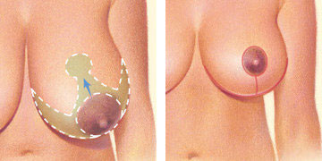 BREAST REDUCTION, Breast Reduction