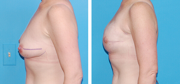 , Breast Reconstruction &#8211; Patient 11