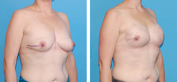 , Breast Reconstruction &#8211; Patient 11