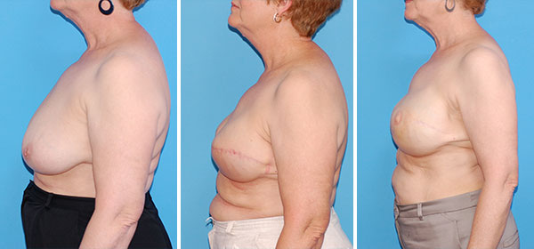 , Breast Reconstruction &#8211; Patient 10