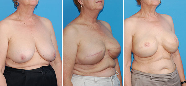 , Breast Reconstruction Patient 10
