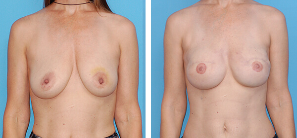 , Breast Reconstruction &#8211; Patient 12