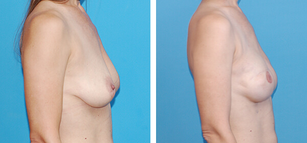 , Breast Reconstruction Patient 12