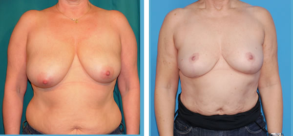 , Breast Reduction &#8211; Patient 36