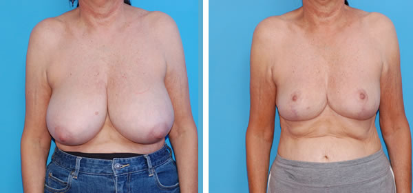 , Breast Reduction &#8211; Patient 37