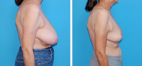 , Breast Reduction – Patient 37