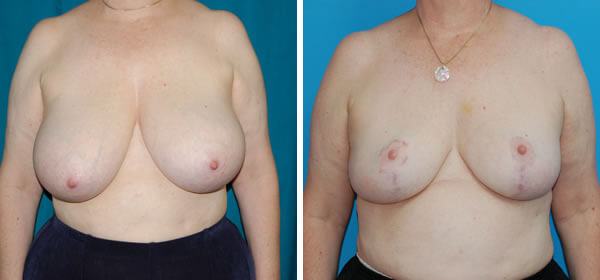 , Breast Reduction – Patient 38
