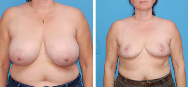 , Breast Reduction &#8211; Patient 39