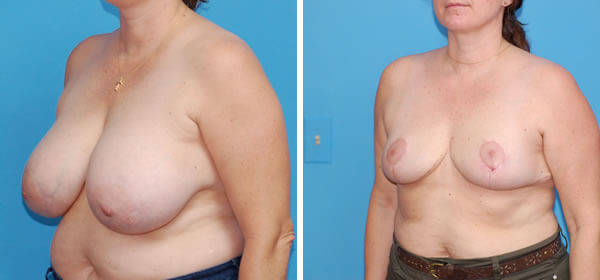 , Breast Reduction &#8211; Patient 39