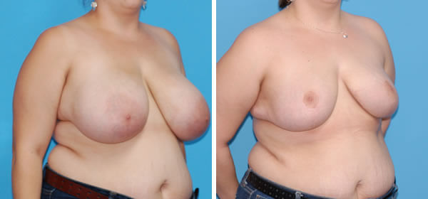 , Breast Reduction &#8211; Patient 41