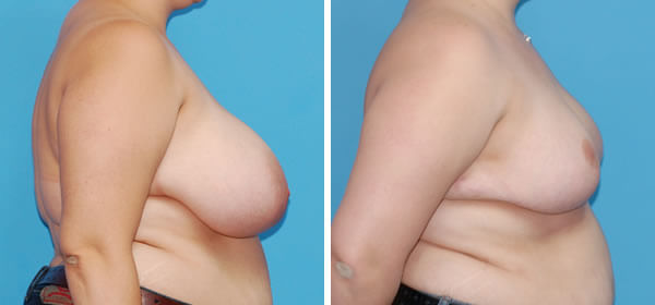 , Breast Reduction &#8211; Patient 41