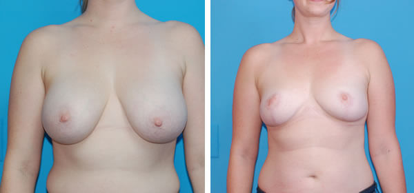 , Breast Reduction &#8211; Patient 42