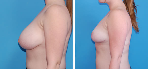, Breast Reduction &#8211; Patient 42