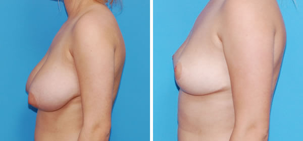 , Breast Reduction – Patient 43