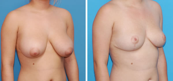 , Breast Reduction &#8211; Patient 43