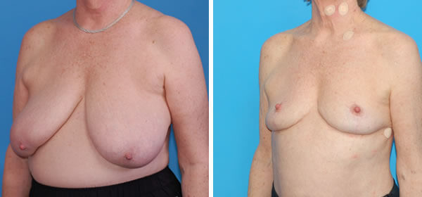 , Breast Reduction &#8211; Patient 44