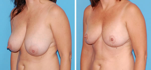 , Breast Reduction – Patient 48