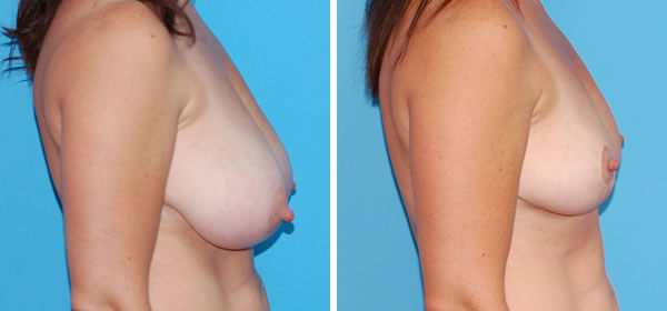 , Breast Reduction – Patient 48