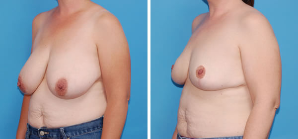 , Breast Reduction – Patient 57