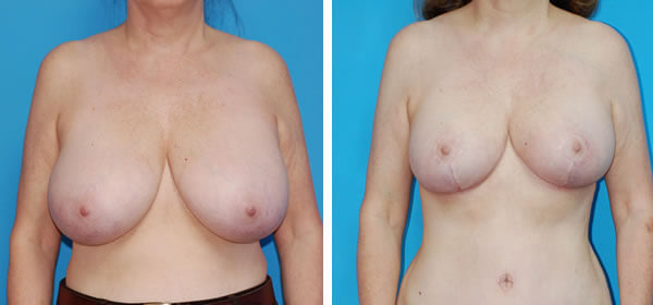 , Breast Reduction – Patient 61
