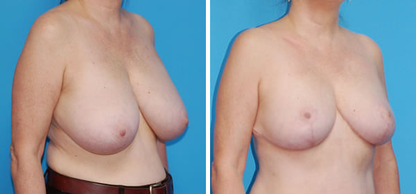 , Breast Reduction – Patient 61