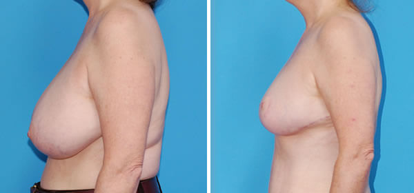 , Breast Reduction &#8211; Patient 61