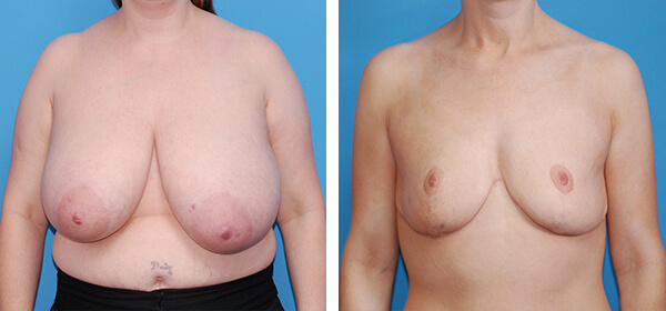 , Breast Reduction &#8211; Patient 63